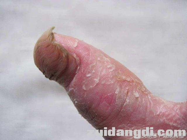 治疗手足癣的一个有效偏方，不花钱不遭罪-2.jpg