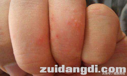 治疗手足癣的一个有效偏方，不花钱不遭罪-3.jpg