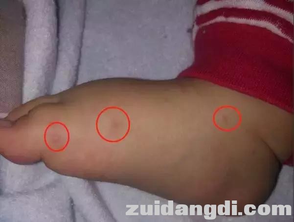 手足口病高发！娃有这4种症状，别犹豫，快就医！-6.jpg