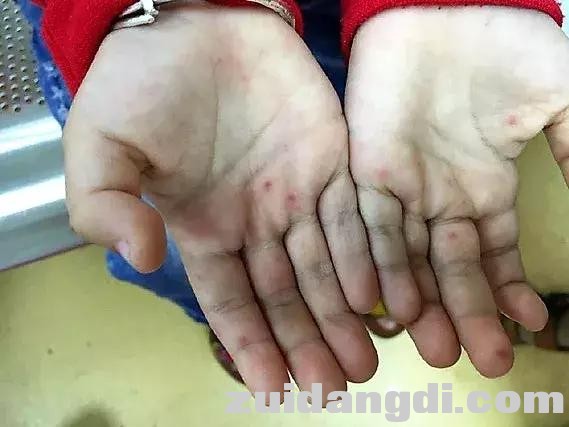 手足口病高发！娃有这4种症状，别犹豫，快就医！-5.jpg